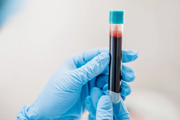 Plazma Kaldırma Kan Tahlili Teşhisi Olan Test Tüpüyle Doktorun Elinin — Stok fotoğraf