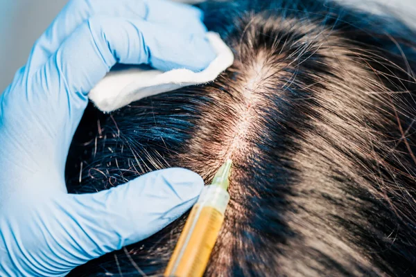 Hair transplantation - hair follicle transplantation - treatment of baldness and strengthening the scalp