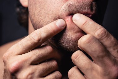 Aynanın önünde kendini tımar ediyorsun. Çenenin ağzının yanındaki sivilcenin yakın çekimi.