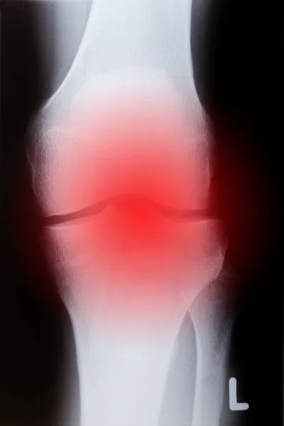 Menselijke knie vooraan — Stockfoto