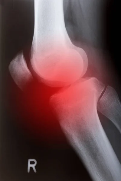 Lidské koleno úkosem — Stock fotografie