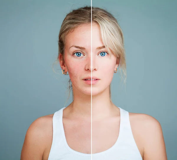 Jeune femme modèle avec un problème de peau. Visage féminin divisé en tw — Photo