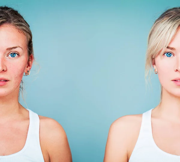 Young Woman with Perfect Skin and Skin Problem. Unhealthy and He — Stock Photo, Image