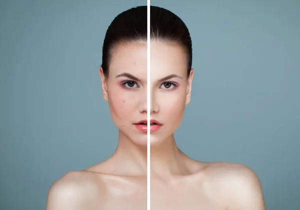 Young Model Woman with Skin Problem and Clear Skin Closeup — Stock Photo, Image