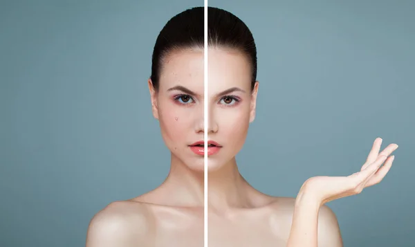 Young Female Face with Skin Problem and Clear Skin — Stock Photo, Image