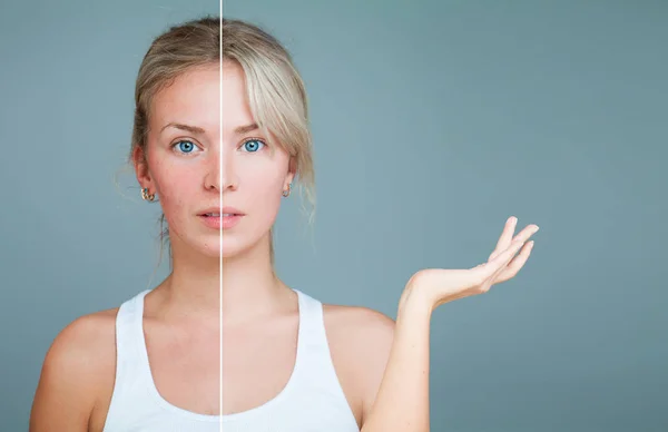 Mujer joven con la mano levantada. Piel poco saludable y saludable después del tratamiento. Tratamiento Facial, Medicina y Cosmetología Concepto. Problema perfecto de piel y piel . — Foto de Stock