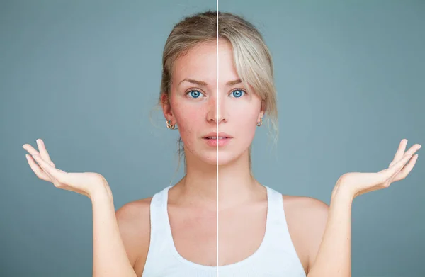 Young Woman with hands raised. Perfect Skin and Skin Problem. — Stockfoto