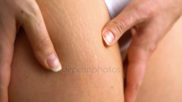 Las estrías femeninas de cadera en la piel — Vídeo de stock