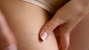 Deri kadın kalça streç işaretleri