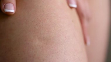 Deri kadın kalça streç işaretleri