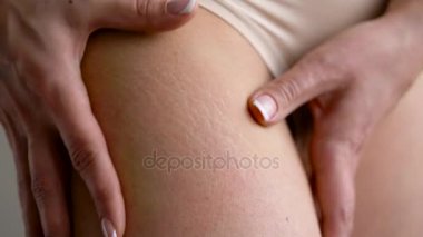 Deri kadın kalça streç işaretleri