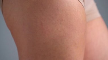 Kadın kalça streç işaretleri ve selülit cilt üzerinde