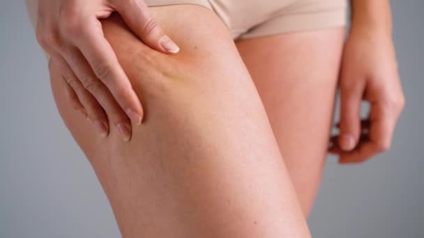 Vrouwelijke hip striae en cellulitis op de huid — Stockvideo