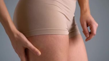 Kadın kalça streç işaretleri ve selülit cilt üzerinde