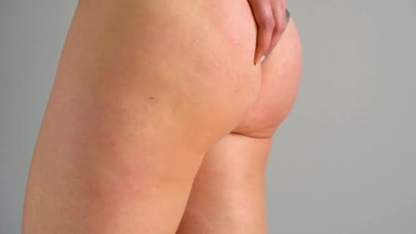 Женские растяжки тазобедренного сустава и целлюлит на коже — стоковое видео