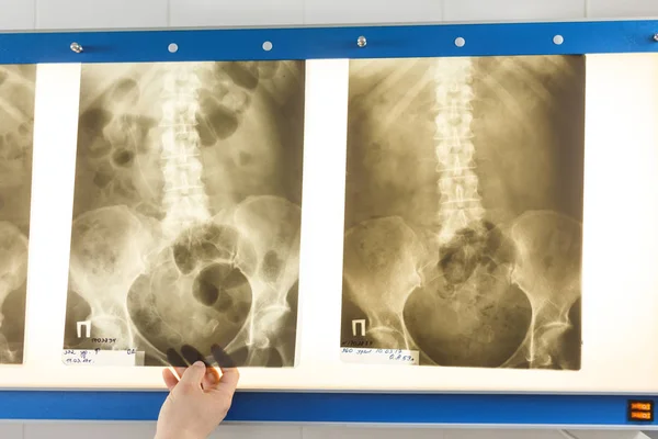 Médico mirando la foto de rayos X de la pelvis — Foto de Stock