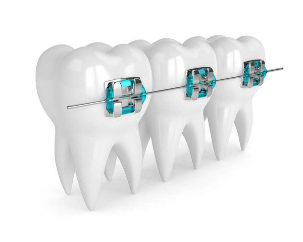 3d render of teeth with braces
