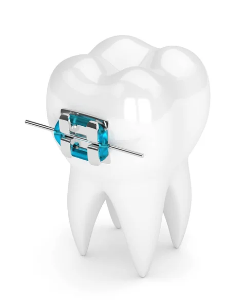 3D візуалізація зуба з брекетом — стокове фото
