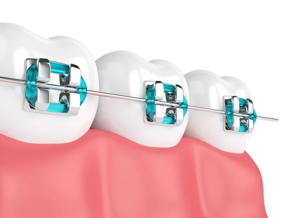 Teeth Bonding Delray Beach  Ocean Breeze Prosthodontics