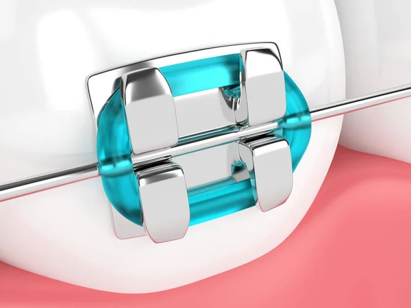 3d render of tooth with brace — Stock Photo, Image