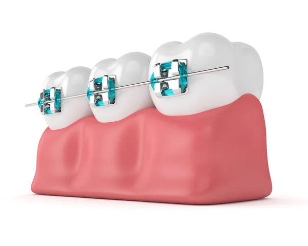 Odwzorowania 3D zębów z szelkami — Zdjęcie stockowe