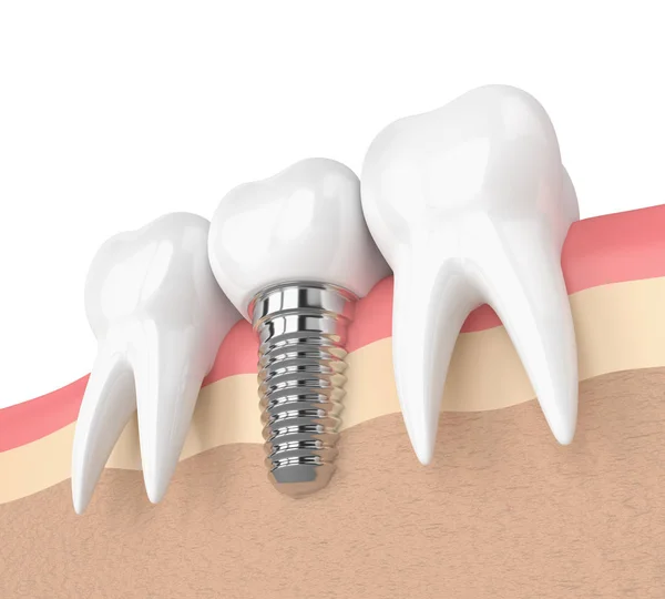 3d renderização de dentes com implante dentário em gengivas — Fotografia de Stock