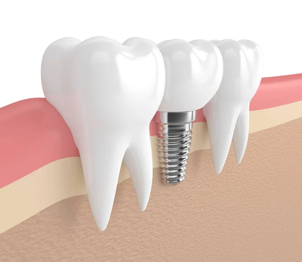 3d render of teeth with dental implant in gums — Stock Photo, Image