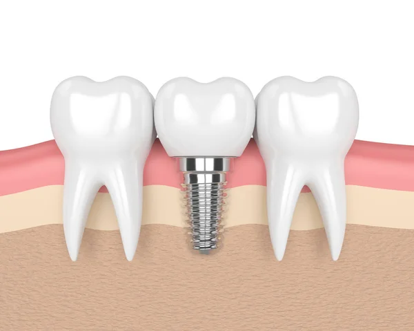 3D renderizado de dientes con implante dental en encías — Foto de Stock