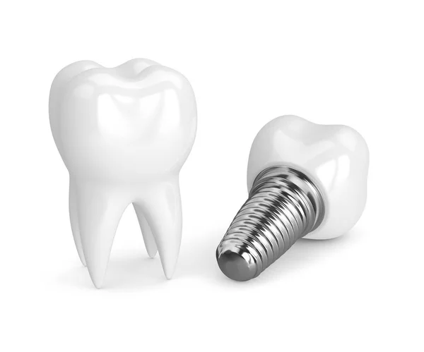 Rendering 3d del dente con impianto dentale — Foto Stock