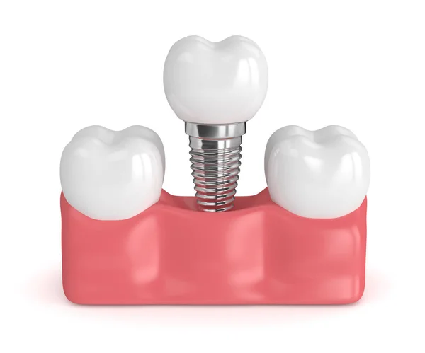 3D renderização de dentes com implante dentário — Fotografia de Stock