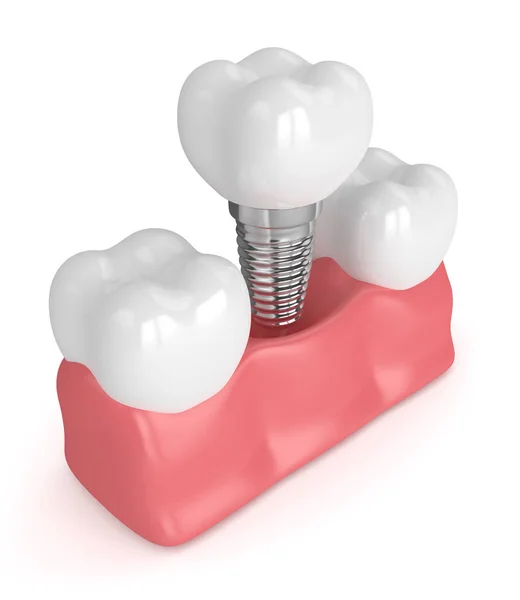 3D renderização de dentes com implante dentário — Fotografia de Stock