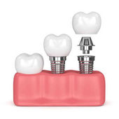 3D-Darstellung von Zahnimplantaten im Zahnfleisch