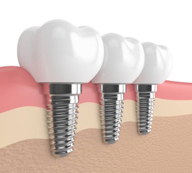 dental implantlar diş etleri içinde 3D render