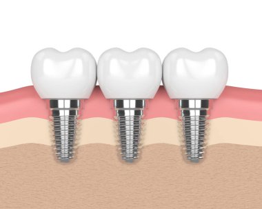 dental implantlar diş etleri içinde 3D render
