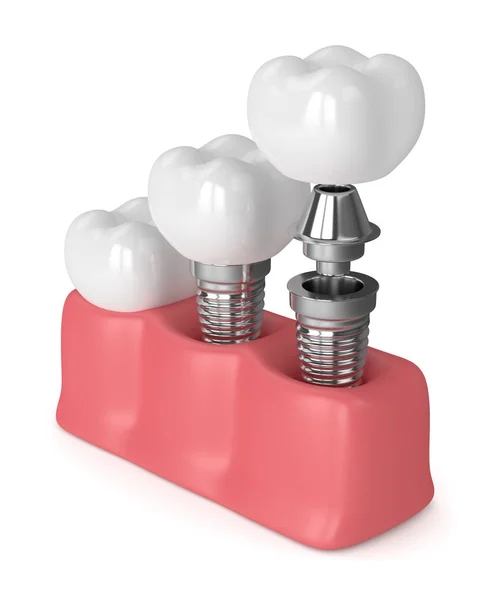 3D render van tandheelkundige implantaten in tandvlees — Stockfoto