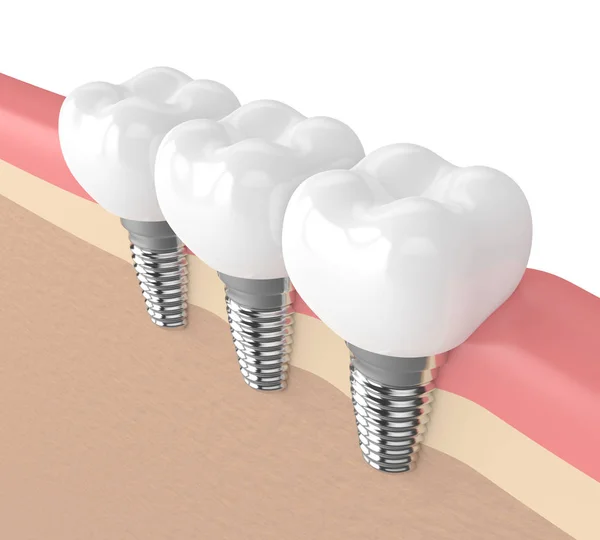3D renderizado de implantes dentales en encías — Foto de Stock