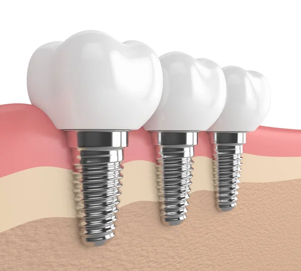 A fogászati implantátumok íny 3D render — Stock Fotó