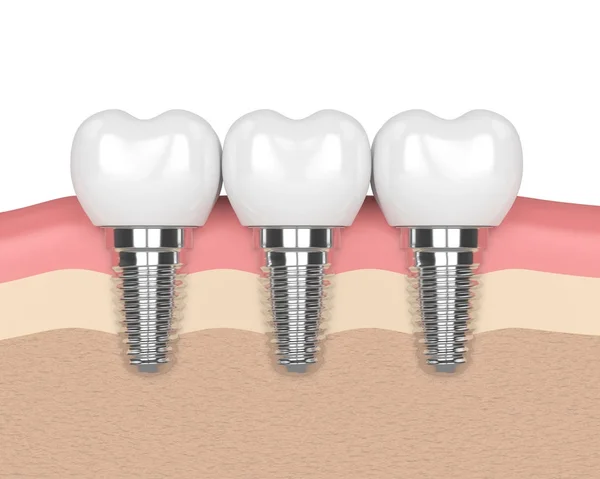 A fogászati implantátumok íny 3D render — Stock Fotó