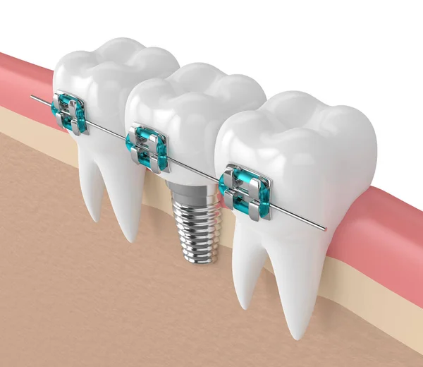 3D render van tanden met implantaat en bretels — Stockfoto