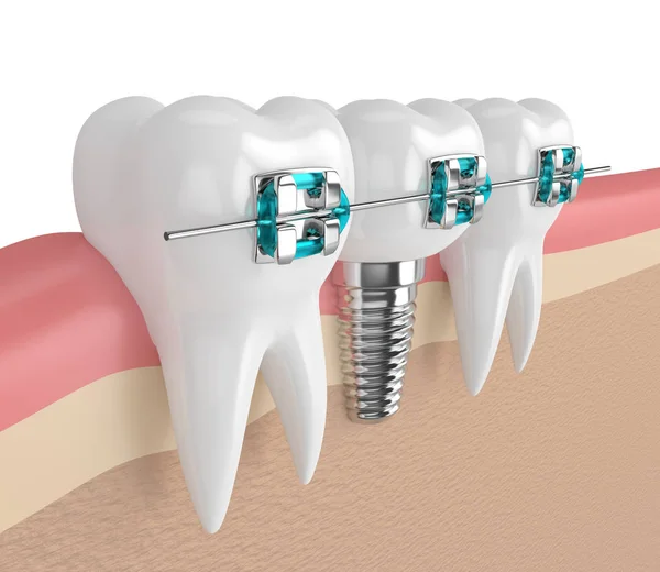 3D візуалізація зубів з імплантатом та брекетами — стокове фото