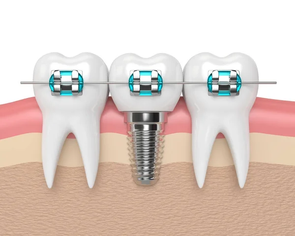 3D renderizado de dientes con implante y aparatos ortopédicos — Foto de Stock
