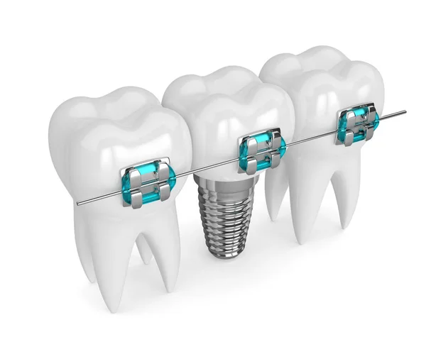 Rendering 3d dei denti con impianto e apparecchio — Foto Stock