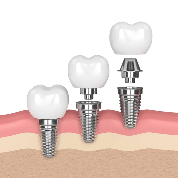 3D render implantów dentystycznych w dziąsła — Zdjęcie stockowe