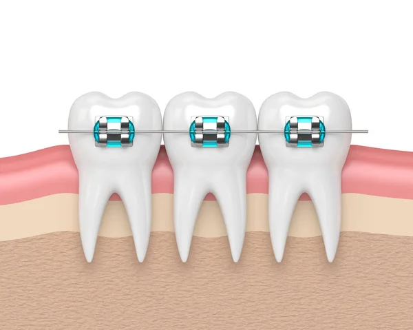 戴着牙套的牙齿的 3d 渲染 — 图库照片