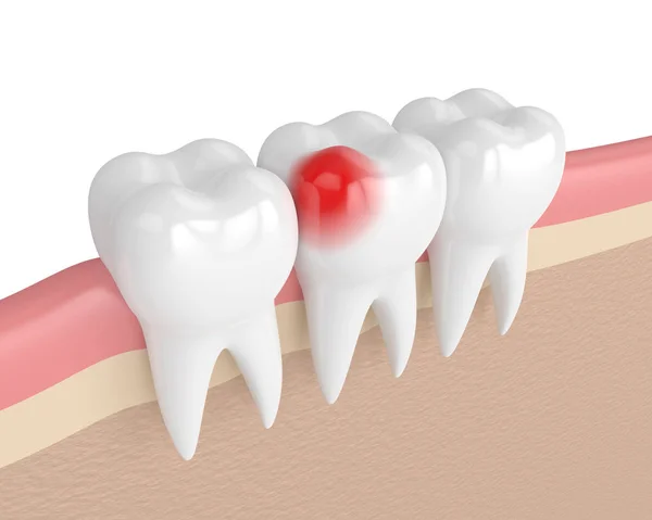 3d render of teeth with toothache in gums — Stock Photo, Image