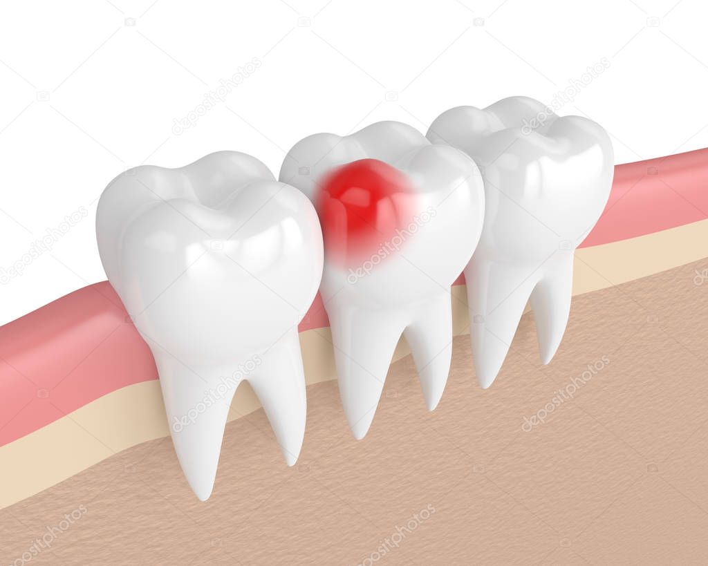 3d render of teeth with toothache in gums