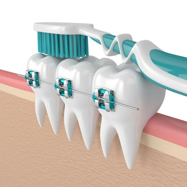 3D-Darstellung der Zähne mit Zahnspange und Zahnbürste — Stockfoto