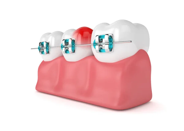 3d renderização de dentes com aparelho — Fotografia de Stock