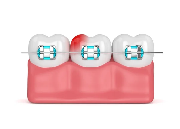 치아 교정기와의 3d 렌더링 — 스톡 사진