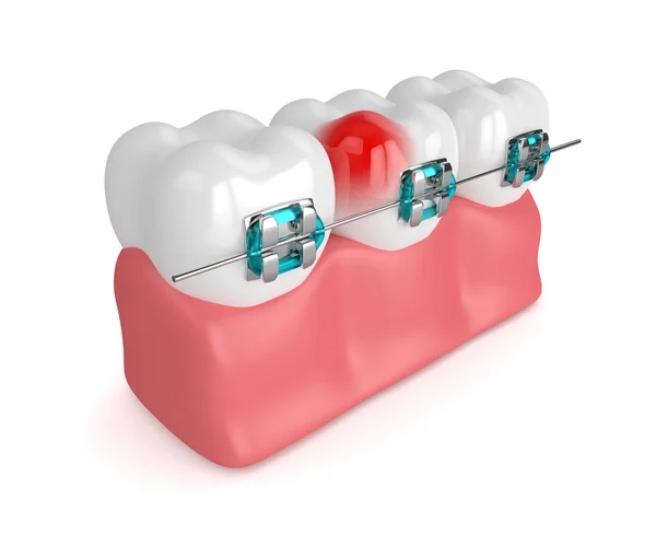 3d renderizado de dientes con aparatos ortopédicos — Foto de Stock